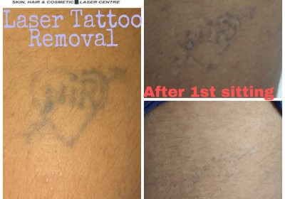 SHILPAN SKIN HAIR AND COSMETIC LASER CENTER