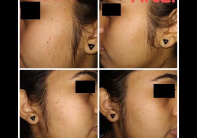 SHILPAN SKIN HAIR AND COSMETIC LASER CENTER